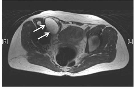 An Axial Mars Mr Image Shows A Type 1 Pseudotumor Arrows Download