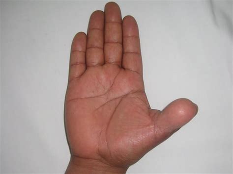 Cirugía De Mano Reconstrucción De Pulgar Con Transferencia De Pié A Mano