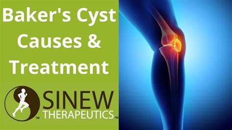 Bakers Cyst Causes And Treatment Youtube