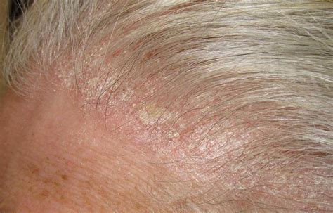 How To Treat A Scabby Scalp Ds Healthcare Group