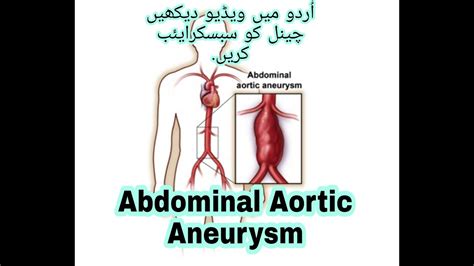 Abdominal Aortic Aneurysm Youtube