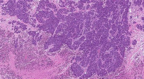 Large Cell Neuroendocrine Carcinoma Of The Lung Atlas Of Pathology