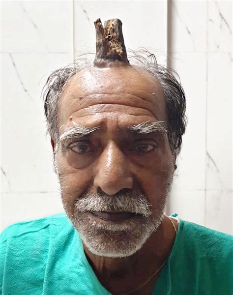 Doctors Remove 10cm Sebaceous Horn From Head Of Indian Man 7news