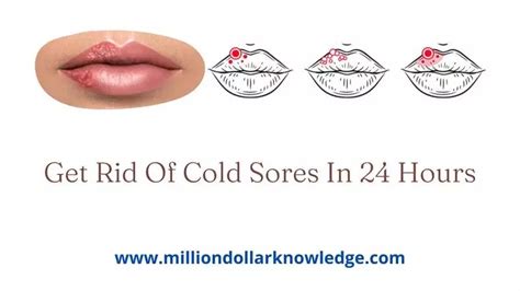 How To Get Rid Of Cold Sores In 24 Hours Million Knowledge