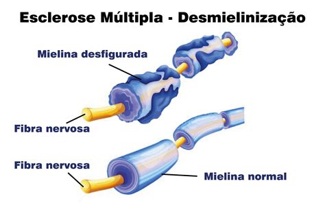 A esclerose múltipla pode lesar. ESCLEROSE MÚLTIPLA - Clínica Dr. Rocha