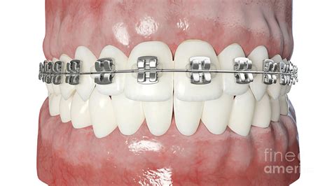 Dental Braces Photograph By Sebastian Kaulitzki Science Photo Library Fine Art America