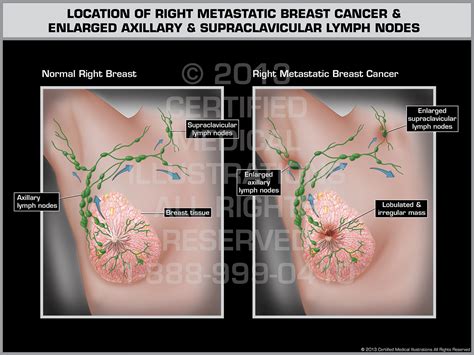 Location Of Right Metastatic Breast Cancer And Enlarged
