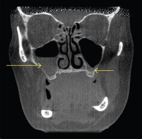 Coronal Ct Scan Demonstrating Bilateral Maxillary Sinus Open I