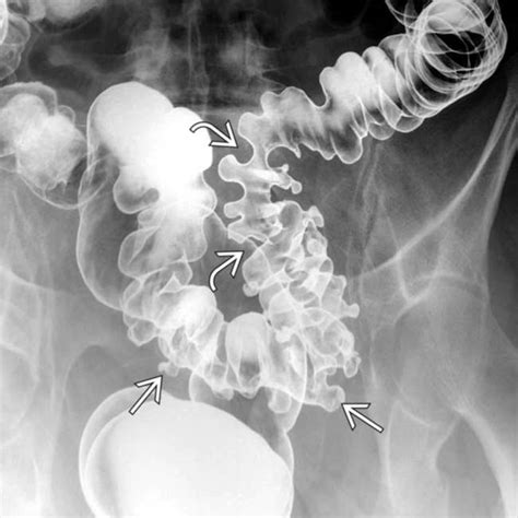 Colonic Diverticulosis Radiology Key