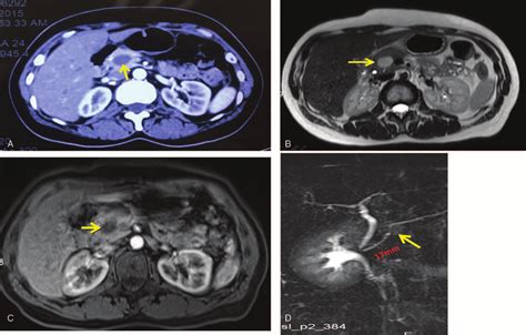 Ct Mri And Mrcp Scans A Contrast Enhanced Ct And B C
