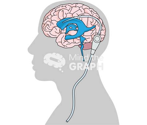 Shunt Procedure Lateral Brain