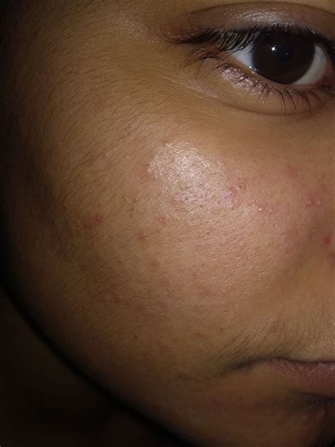 Sudden Tiny Bumps On Face General Acne Discussion Acne Org My Xxx Hot