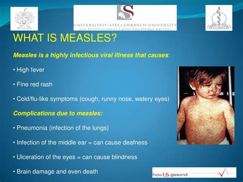Ppt Measles Powerpoint Presentation Free Download Id1465716