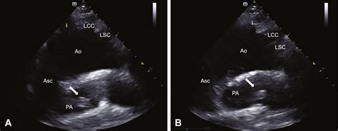 Bedside Cardiac Ultrasound Suprasternal Notch View Detected Pulmonary