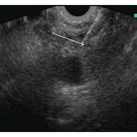 Images Of Endoscopic Ultrasound In Advanced Pancreatic Cancer A