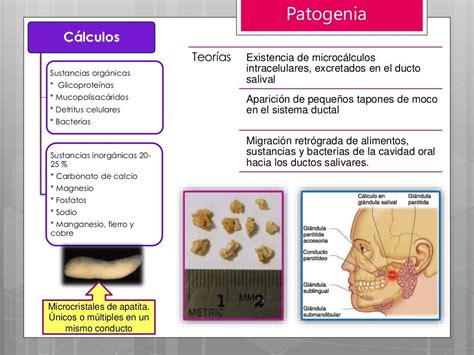 Sialolitiasis Patología De Las Glándulas Salivales
