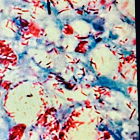 Mycobacterium Tuberculosis Part Afb Stain Acid Fast Bacilli