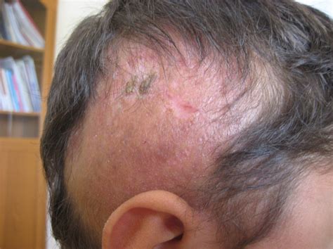 Experimental Drug Reverses Hair Loss And Skin Damage Linked To Fatty