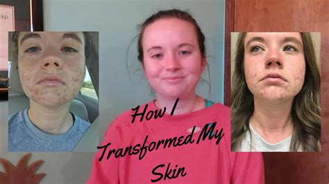 How I Cleared My Skin Accutane Story Skin Care Routine Youtube