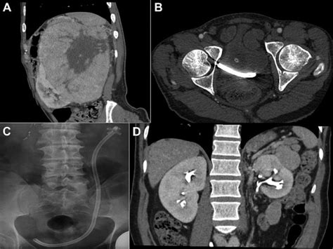 Prolonged Urinary Leakage After Partial Nephrectomy A Novel Management Pathway Urology