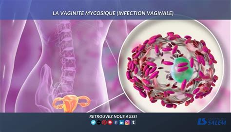 Tout Ce Quil Faut Savoir Sur La Mycose Vaginale Et La Mycose Du Gland