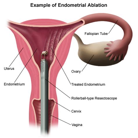 Endometrial Ablation Newton Wellesley Hospital Greater Boston Area