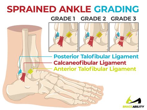 Anterior Ankle Ligament Tear