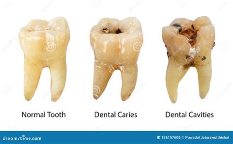 Normal Tooth Dental Caries And Dental Cavity With Calculus