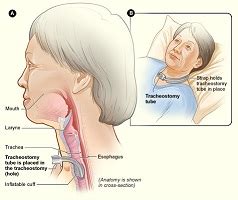Tracheostomy Indication Patient Management Study