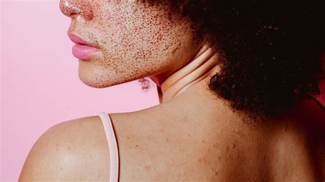 What Causes Red Spots On Skin Dermatologists Explain Marie Claire