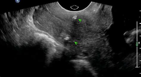 Value Of Transvaginal Sonography After Cervical Cerclage Bronshtein 2017 Ultrasound In