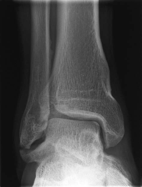 Figure 1 From A Case Of Pseudoarthrosis Of The Lateral Talar Process