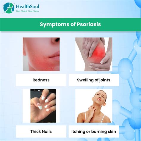 Symptoms And Diagnosis Of Psoriasis