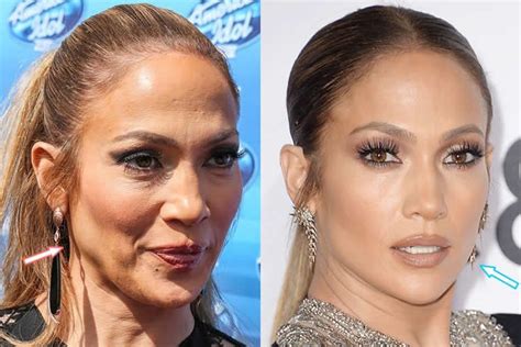 Jennifer Lopez Botox And Facelift Before And After