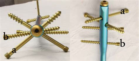Angle Stable Interlocking Intramedullary Nails For Tibial Plateau