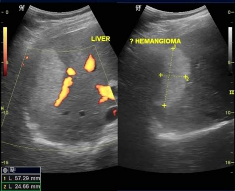 Hepatic Hemangioma Image