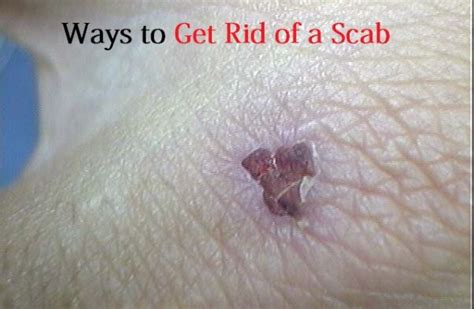 How To Get Rid Of A Scab