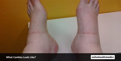 What Are Cankles And How To Get Rid Of Them All You Need To Know
