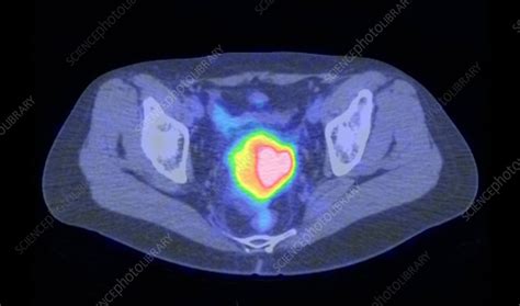 Cervical Cancer Ct And Pet Scans Stock Image C0017974 Science