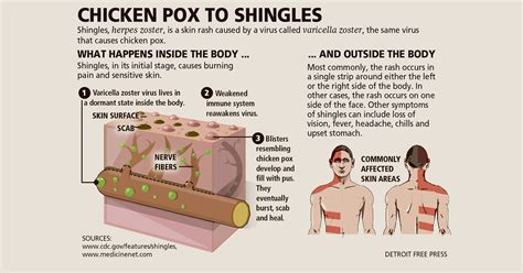 What You Need To Know About Shingles Infections