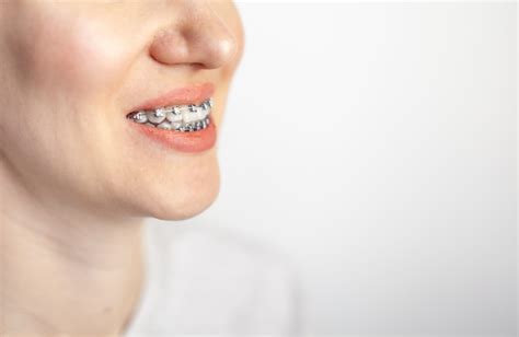 Улыбка молодой девушки с брекетами на ее белых зубах выпрямление зубов Премиум Фото