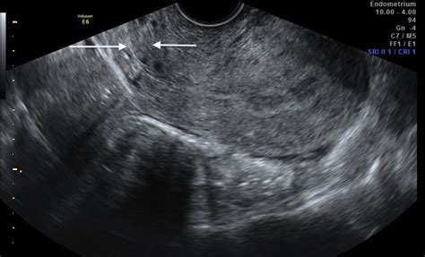 Transvaginal Ultrasound Displaying One Internal Cervical Os Black
