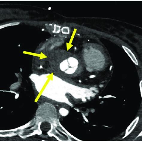 Computed Tomography Angiography Showing A Collection Around The Aortic