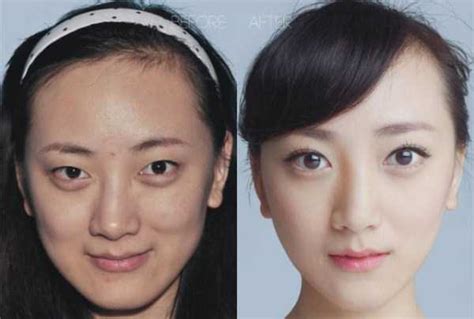 Chinese Women Before And After Plastic Surgery Procedures 19 Photos