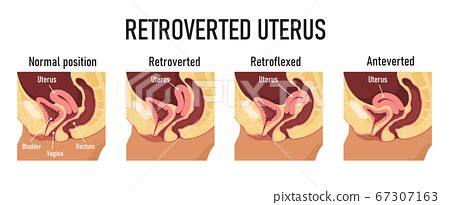 Retroverted Uterus Exercises