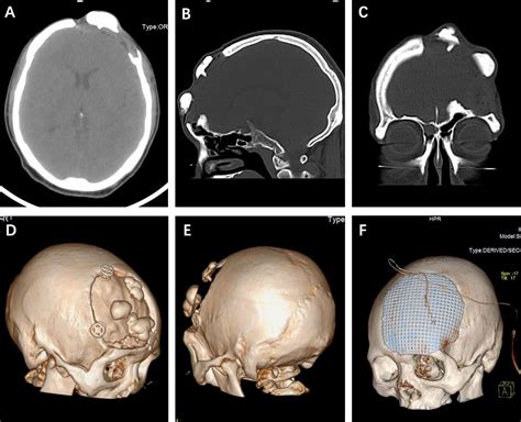 Frontiers Relapse Of Skull Osteoma After Hydroxyapatite Cement