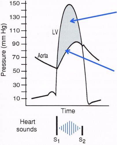 heart murmurs valve auscultations and normal cardiac pressures flashcards quizlet