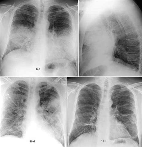 Legionella pneumophila serogroup 1 pneumonia recurrence postbone marrow transplantation. Legionellen-Pneumonie Verlauf