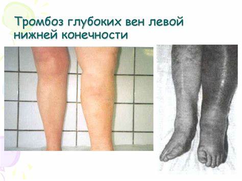 Диета для тромбоза глубоких вен Тромбоз глубоких вен нижних конечностей - презентация онлайн Тромбоз глубоких вен нижних конечностей - презентация онлайн Диета для тромбоза глубоких вен