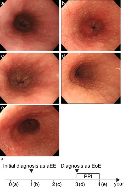 Representative Endoscopic Pictures During Time Course Of Case 4 A